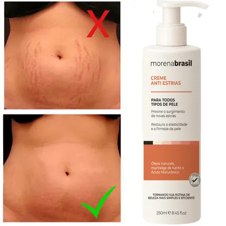 Creme Anti-Estrias - Diga Adeus às Estrias! Previne Novas Estrias & Reforça a Elasticidade da Pele